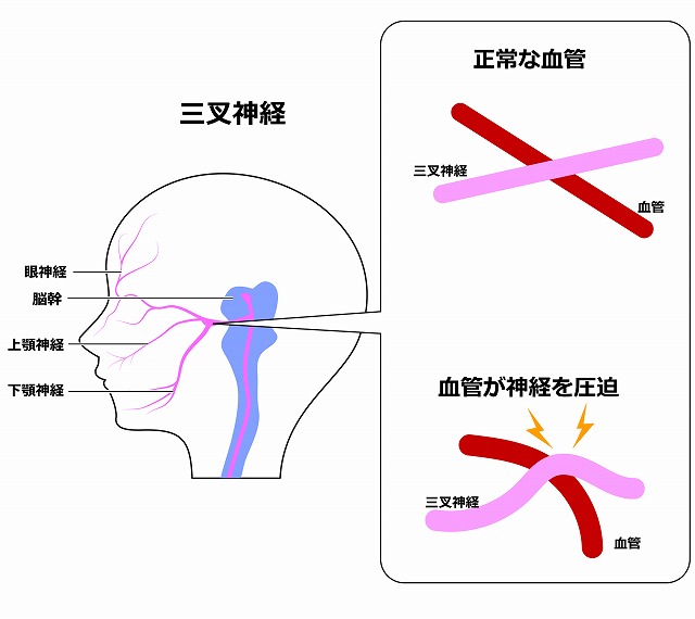 三叉神経痛の原因