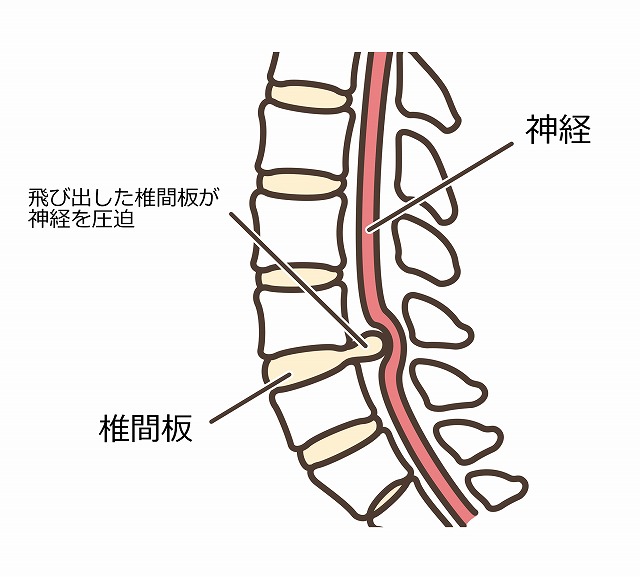 頸椎椎間板ヘルニアとは
