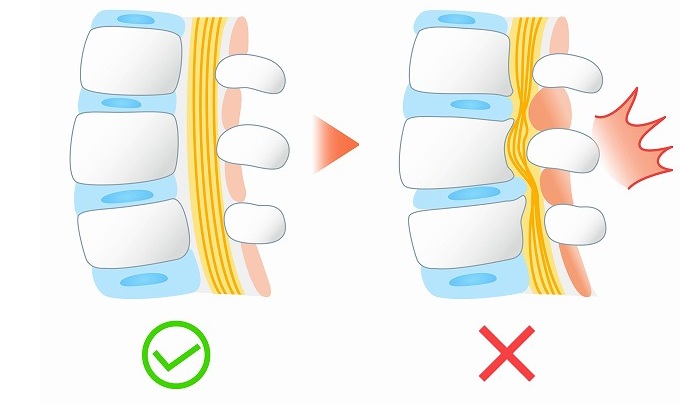 脊柱管狭窄症とは