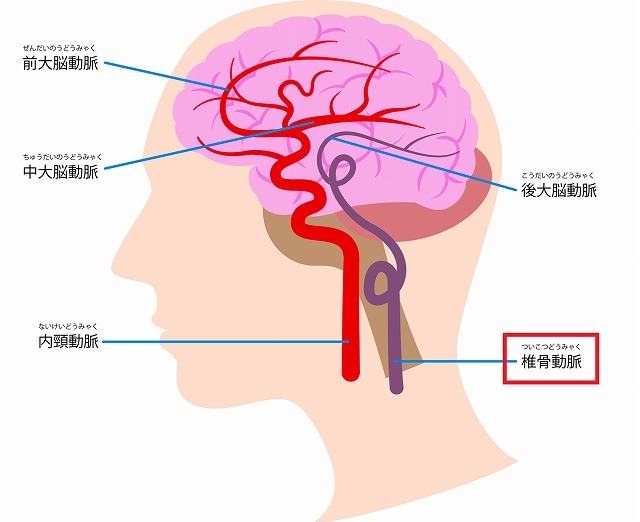 椎骨動脈解離とは